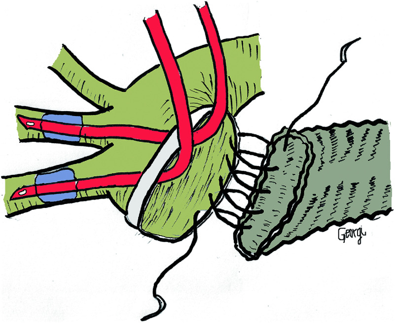 Can Open Distal Repair Be Safely Used in All Patients with Type A Acute Aortic Dissection?