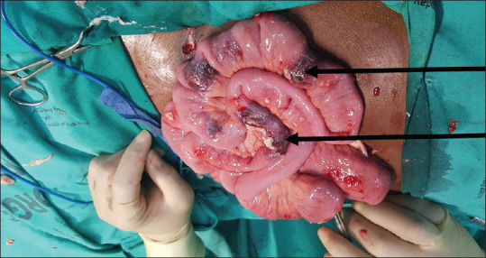 Multiple Gastrointestinal Haemangiomatosis: A Report of Two Cases.