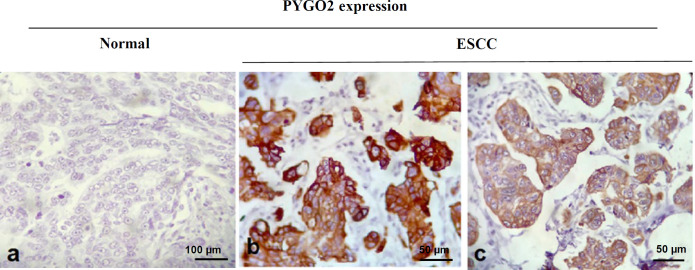 Histopathological Evaluation of PYGO2 Expression in Esophageal Squamous Cell Carcinoma.