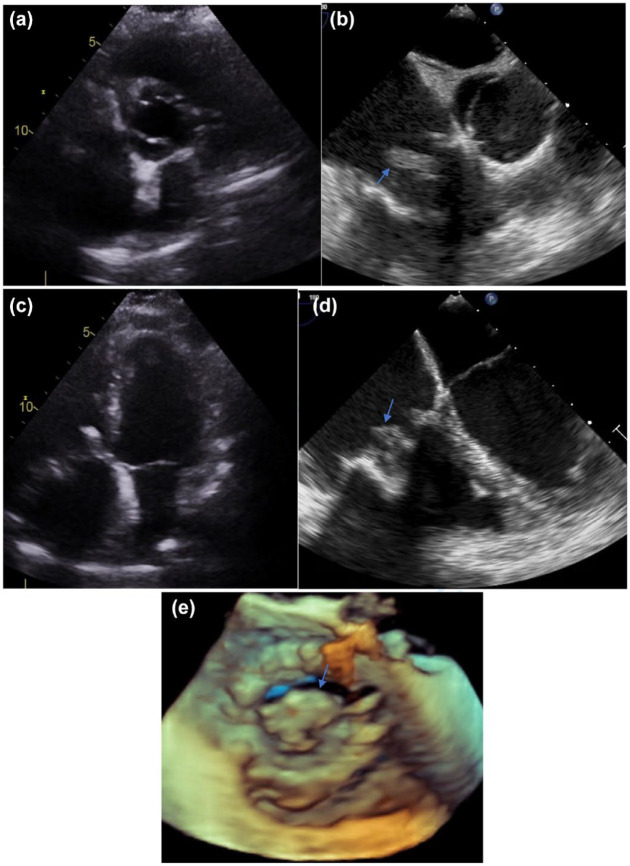 Relevance of cardiac imaging in the evolving landscape of infective endocarditis management.