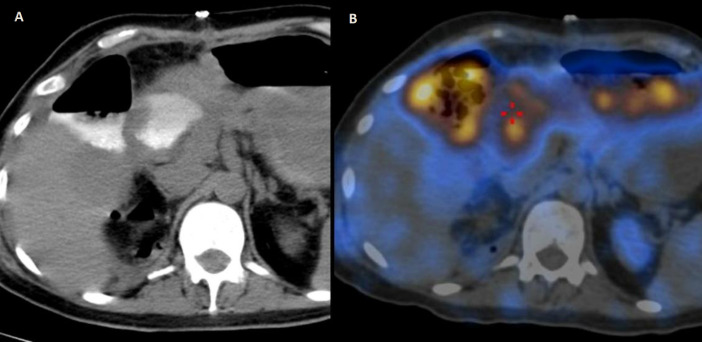 Incidental diagnosis of intestinal perforation on a <sup>99m</sup>Tc DTPA renogram.