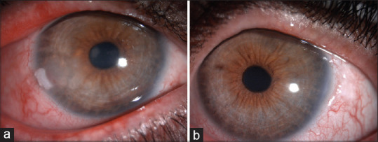 Corneal Endothelial Toxicity Secondary to Topical 5-fluorouracil.