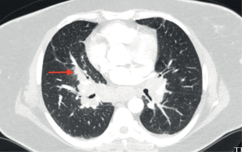 [Development of sarcoidosis after successful treatment of Cushing's disease].