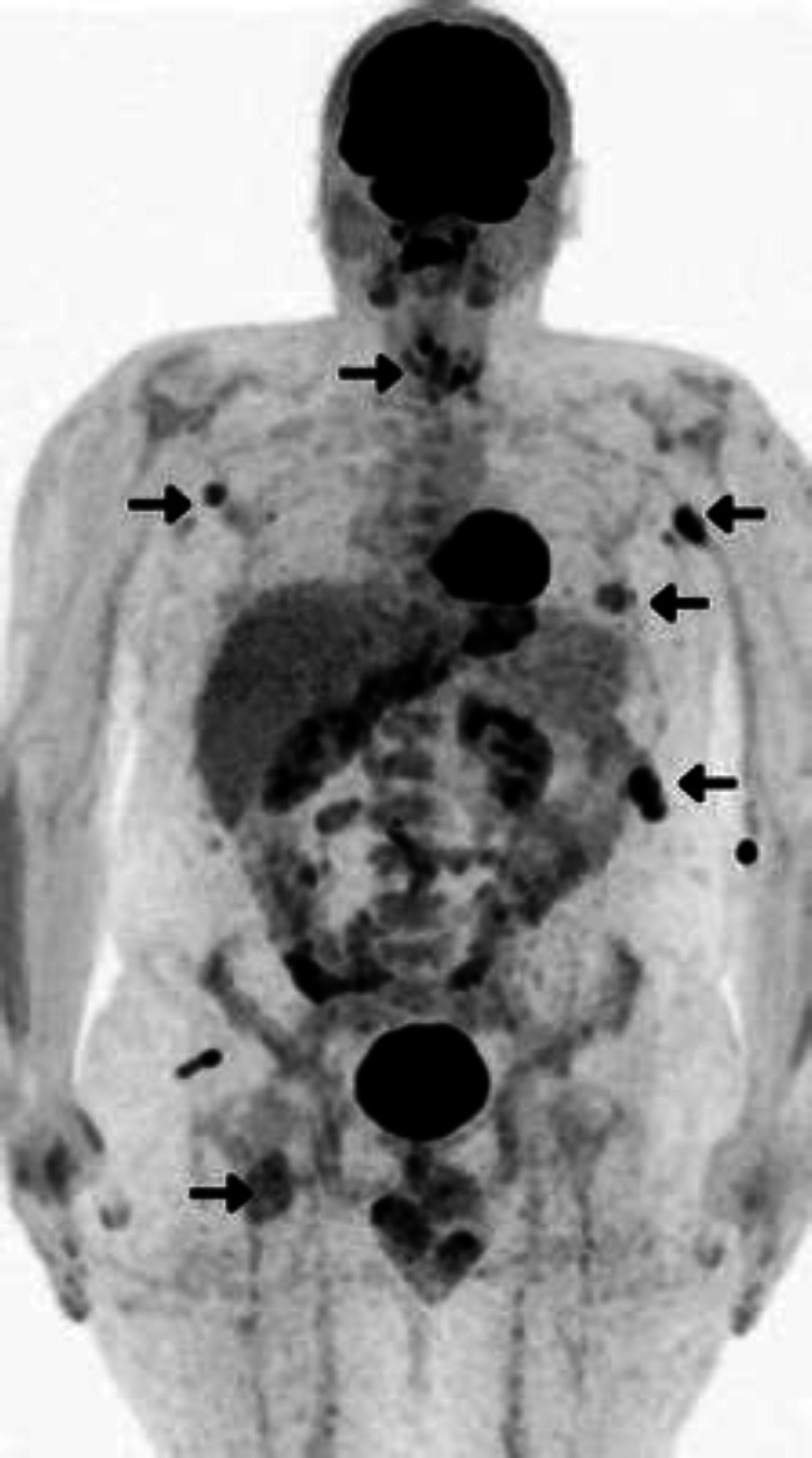 A rare presentation of thyroid malignant peripheral nerve sheath tumor in neurofibromatosis type 1 delineated by FDG PET/CT: A case report and literature review.