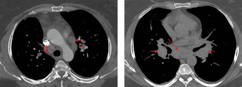 [Development of sarcoidosis after successful treatment of Cushing's disease].