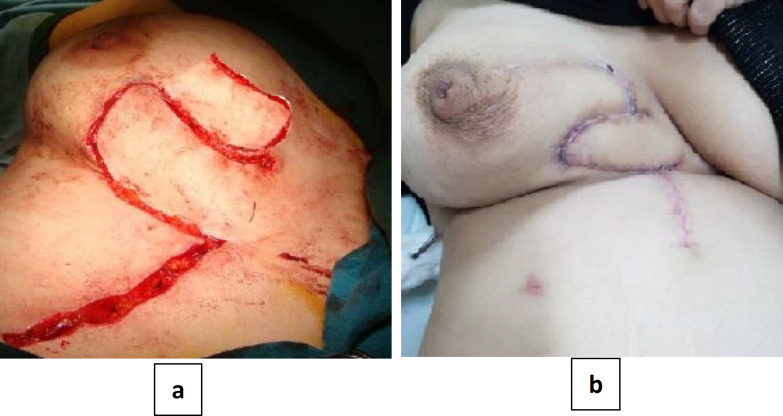 Medial Breast Reconstruction after Breast Conserving Surgery with Local Flap: A Single Center Experience.