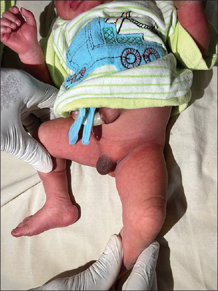 Penile Agenesis Associated with Anorectal Malformation and Bilateral Renal Agenesis: A Case Report and a Review of the Literature.