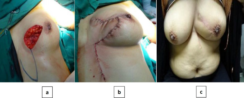 Medial Breast Reconstruction after Breast Conserving Surgery with Local Flap: A Single Center Experience.