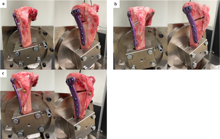 Comparative biomechanical analysis of tibial posterior slope in medial open wedge high tibial osteotomy vs. distal tuberosity osteotomy with and without anterior-posterior screw: a study using porcine tibia.