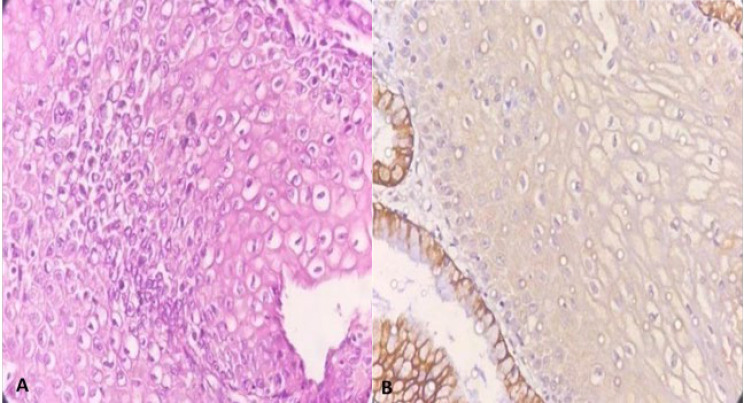 Role of CK7 Immunoreactivity in Predicting Progression of the Cervical Intraepithelial Neoplasia: A Retrospective Cross-sectional Study.