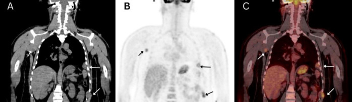 A rare presentation of thyroid malignant peripheral nerve sheath tumor in neurofibromatosis type 1 delineated by FDG PET/CT: A case report and literature review.