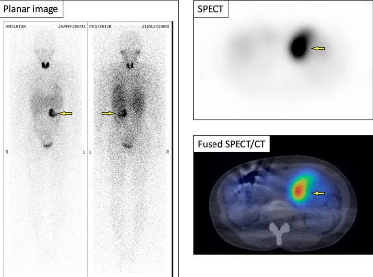 Effectiveness of <sup>18</sup>F-FDG PET/CT in finding lung metastasis from a retroperitoneal paraganglioma.