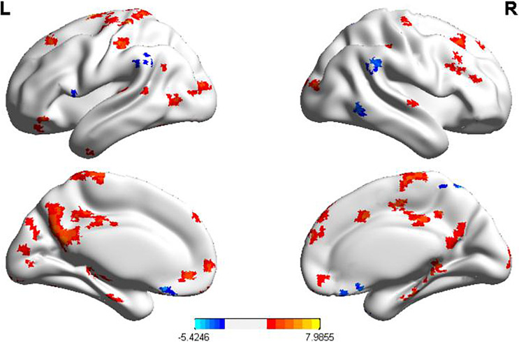 Effects of Transcranial Direct Current Stimulation on Graph Naming Function and Brain Connectivity in Postinfarction Aphasia Patients: An fMRI Study.