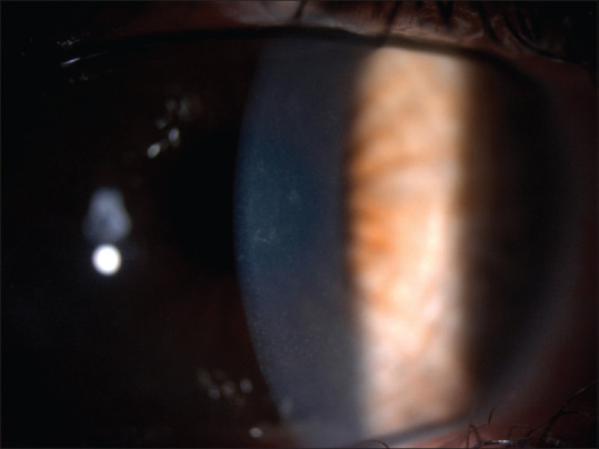 Corneal Endothelial Toxicity Secondary to Topical 5-fluorouracil.