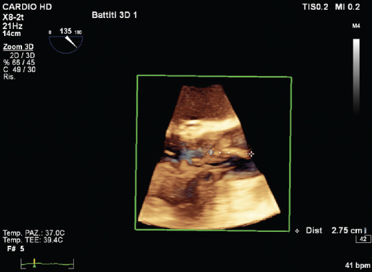 Three-dimensional Transesophageal Echocardiography in Infective Endocarditis: What Does It Add?