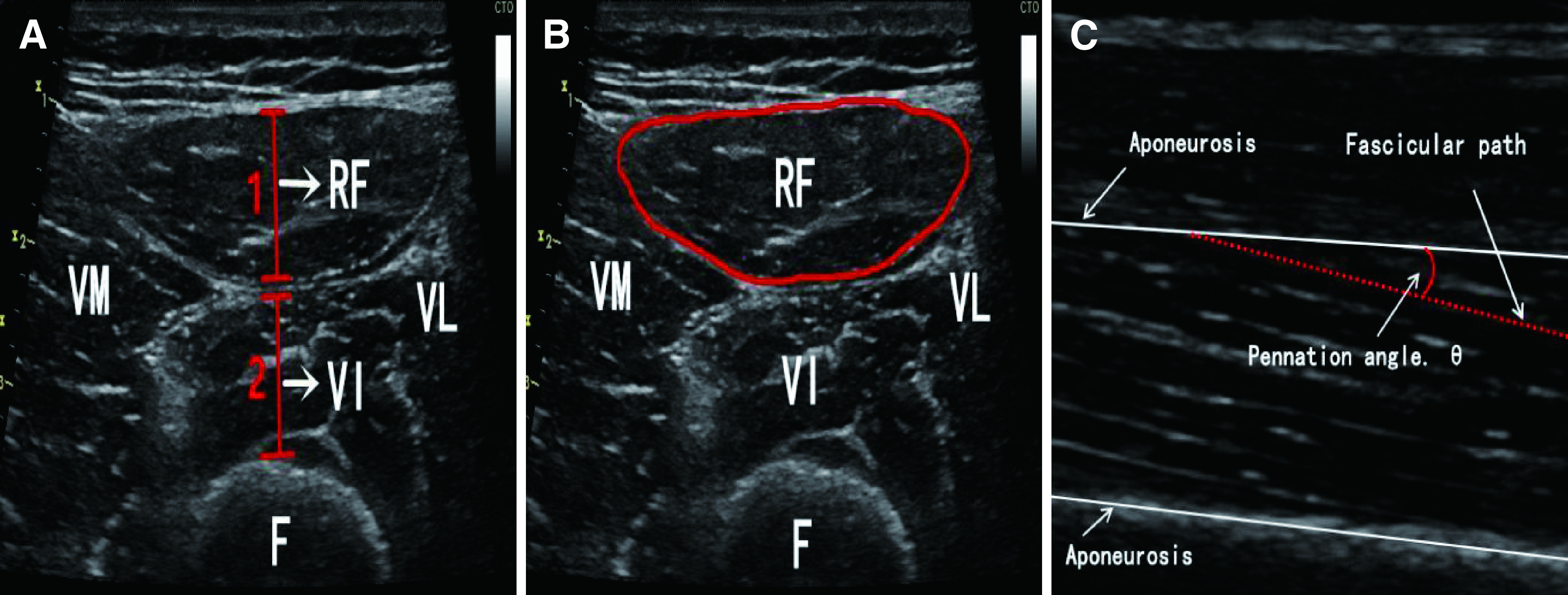 A Predictive Nomogram for Intensive Care-Acquired Weakness after Cardiopulmonary Bypass.