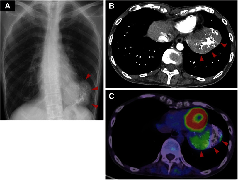 Thoracoscopic Wedge Resection for Low-Grade Fibromyxoid Sarcoma (Evans Tumor) with Massive Calcification and Originating from the Lung: A Rare Case in an Unexpected Location.