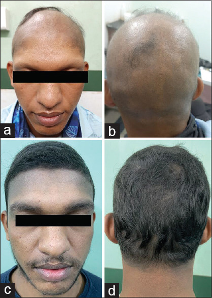 Successful Remission with Combination of Diphenylcyclopropenone and Apremilast in Refractory Extensive Alopecia Areata.
