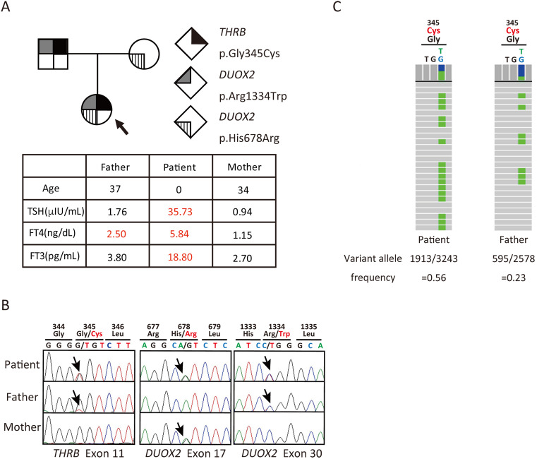 Concurrent <i>THRB</i> and <i>DUOX2</i> variants in a patient detected via newborn screening for congenital hypothyroidism: a case of resistance to thyroid hormone.