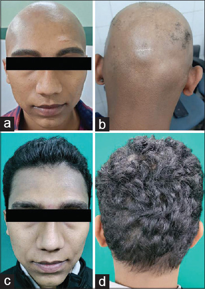 Successful Remission with Combination of Diphenylcyclopropenone and Apremilast in Refractory Extensive Alopecia Areata.