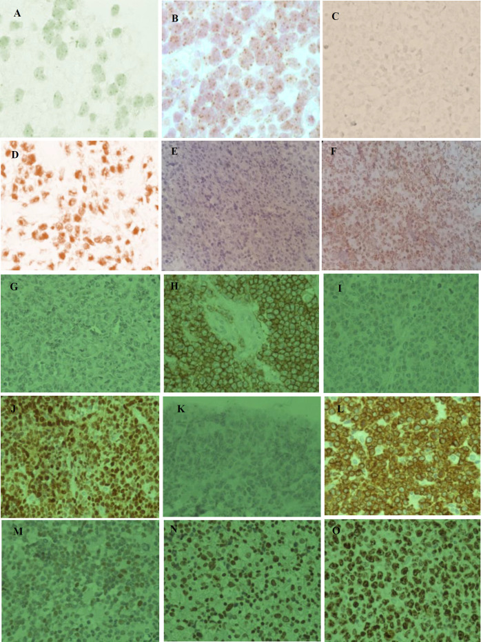 O-6-Methylguanine-DNA Methyltransferase, C-MYC, and EBER Status in Diffuse Large B-Cell Lymphoma of Central Nervous System.