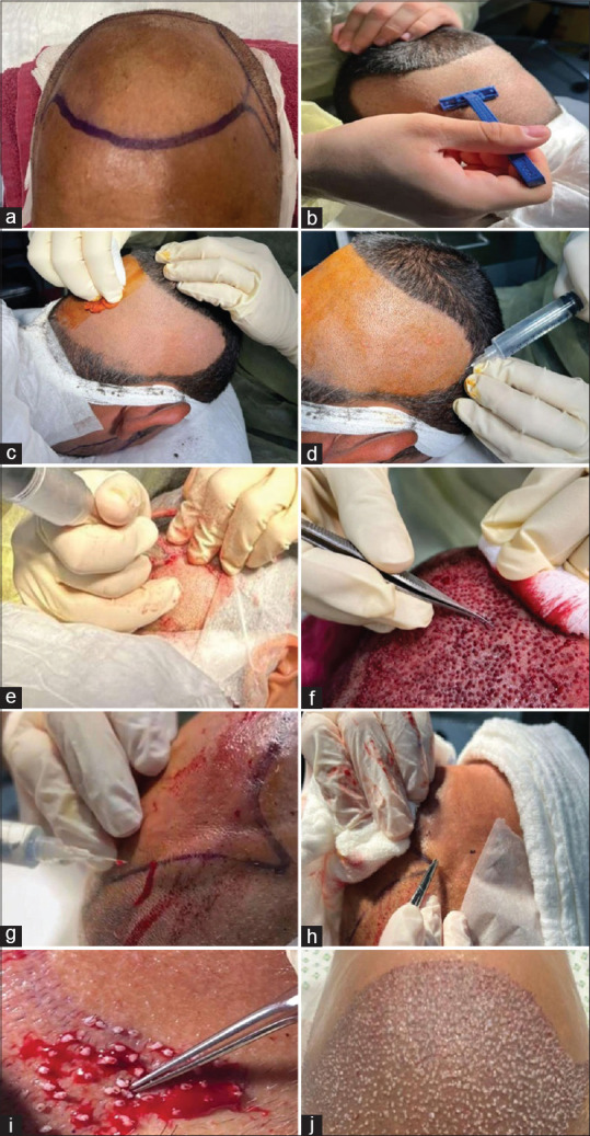 Evaluation of Follicular Unit Extraction Technique as a Method for Hair Restoration Problems.