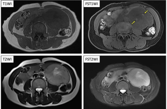 Effectiveness of <sup>18</sup>F-FDG PET/CT in finding lung metastasis from a retroperitoneal paraganglioma.