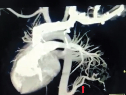 Hybrid Pulmonary Sequestration, Cystic Pulmonary Adenomatoid Malformation, and Dextrocardia: A Triple Whammy.