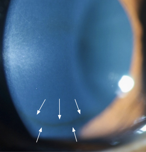 Keratoconus: an introduction.