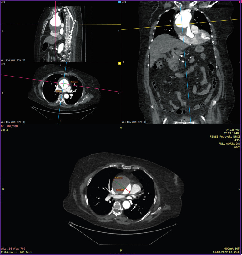 Potential of Current Direct Mechanical Testing Methods in Assessing Intraoperative Samples of Aortic Aneurysm Caused by Uncontrolled Arterial Hypertension.
