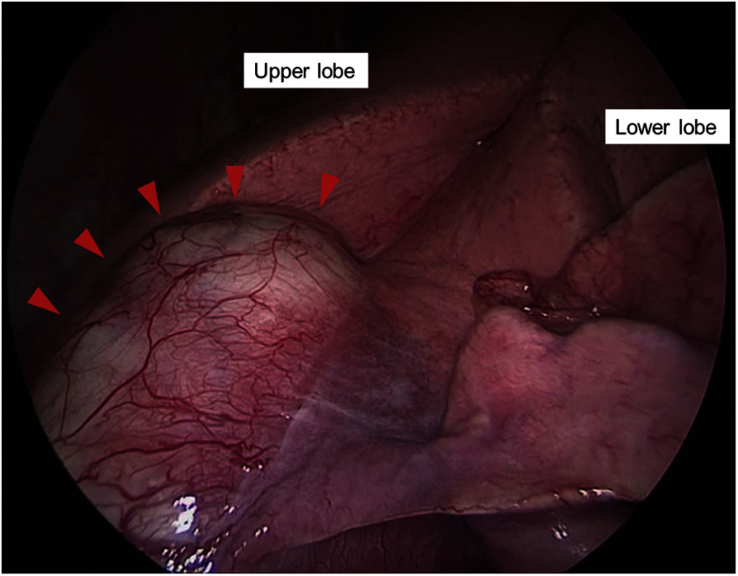 Thoracoscopic Wedge Resection for Low-Grade Fibromyxoid Sarcoma (Evans Tumor) with Massive Calcification and Originating from the Lung: A Rare Case in an Unexpected Location.