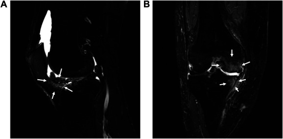 Pathology of knee osteoarthritis pain: contribution of joint structural changes and pain sensitization to movement-evoked pain in knee osteoarthritis.