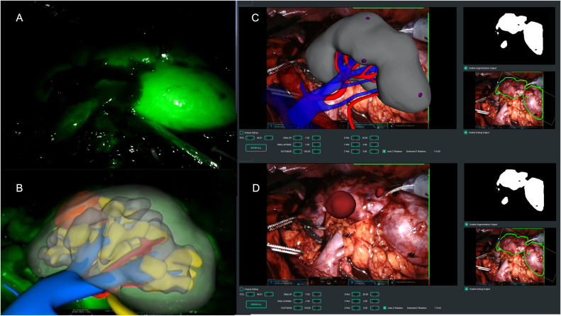 Computer Vision and Machine-Learning Techniques for Automatic 3D Virtual Images Overlapping During Augmented Reality Guided Robotic Partial Nephrectomy.