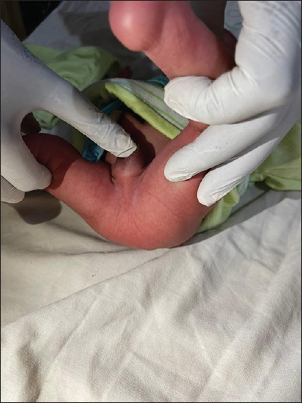 Penile Agenesis Associated with Anorectal Malformation and Bilateral Renal Agenesis: A Case Report and a Review of the Literature.