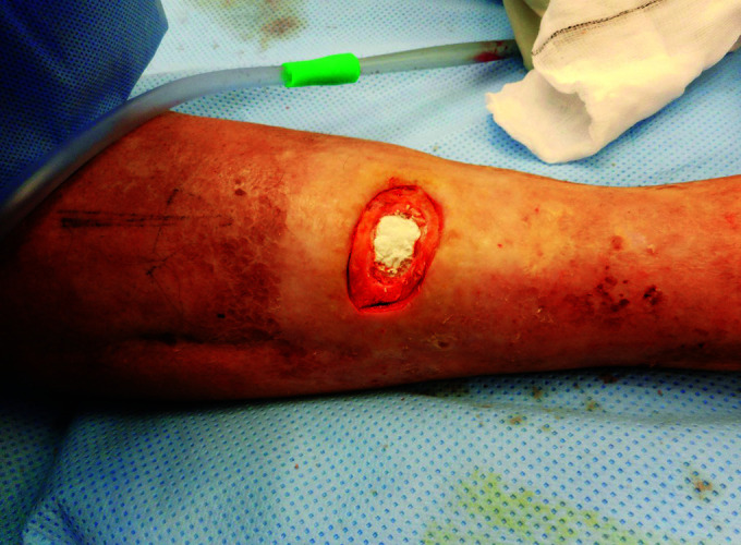 Clinical Outcome following Management of Severe Osteomyelitis due to Pin Site Infection.