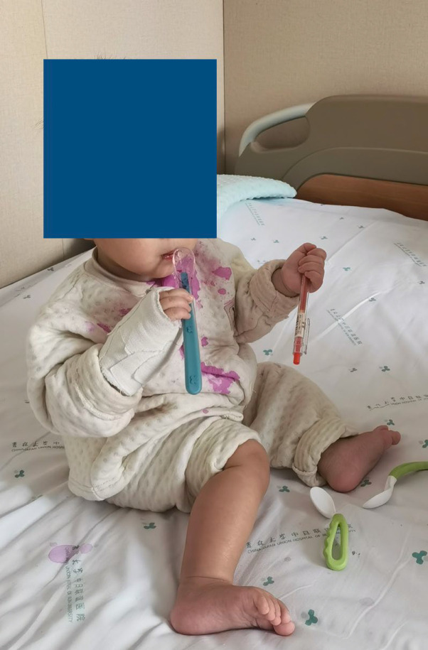 A Bulky Dressing Immobilization for the Congenital Hand Differences in Children.