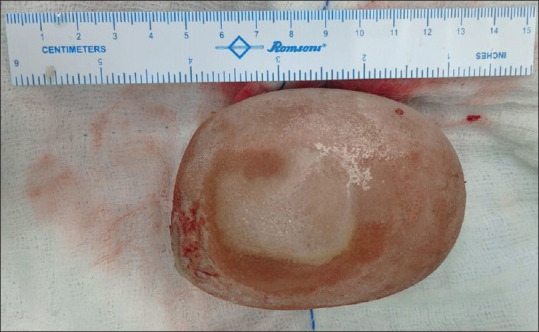 Giant Colpolithiasis in Urogenital Sinus Anomaly with Urethral Duplication: A Case Report and Review of Literature.