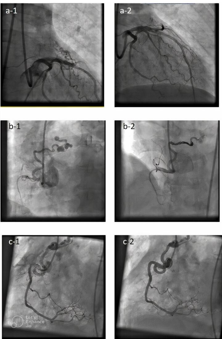 Clinical outcomes of transcatheter closure of congenital coronary artery fistula in 28 cases.