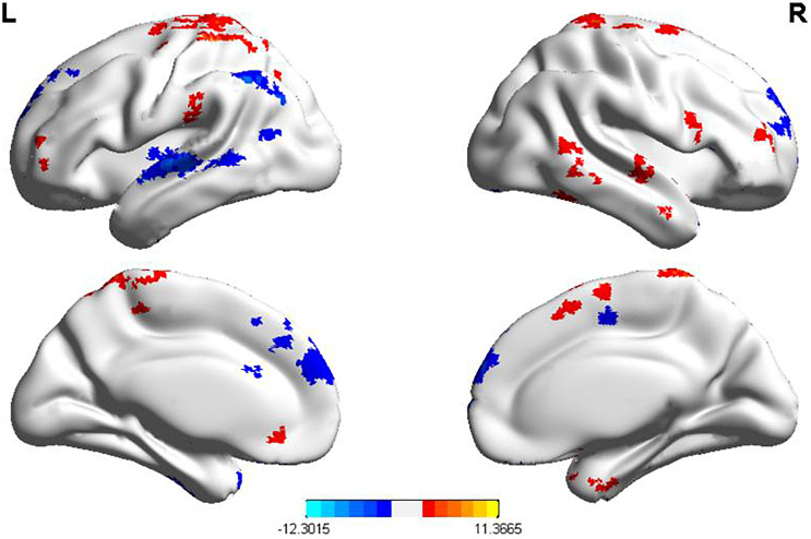 Effects of Transcranial Direct Current Stimulation on Graph Naming Function and Brain Connectivity in Postinfarction Aphasia Patients: An fMRI Study.