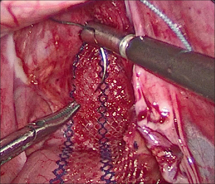 Management of Complete Persistent Rectal Prolapse in Children: A Comparative Study Between Mesh Repair Versus Suturing Rectopexy.