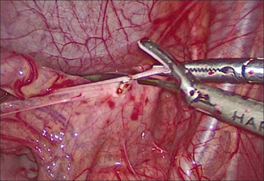 Management of Complete Persistent Rectal Prolapse in Children: A Comparative Study Between Mesh Repair Versus Suturing Rectopexy.