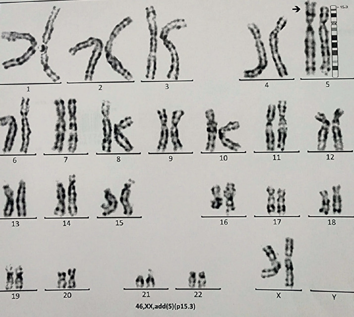 Unbalanced Translocation in a Phenotypically Normal Male Patient Detected by Karyotyping and Array-comparative Genomic Hybridization.