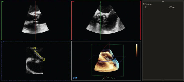 Three-dimensional Transesophageal Echocardiography in Infective Endocarditis: What Does It Add?