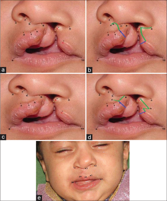 The Outcomes of Modified Millard Technique Versus Tennison-Randall Technique in Unilateral Cleft Lip Repair: A Comparative Trial.