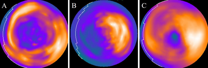 Physiological myocardial <sup>18</sup>F-FDG uptake pattern in oncologic PET/CT: comparison with findings in cardiac sarcoidosis.