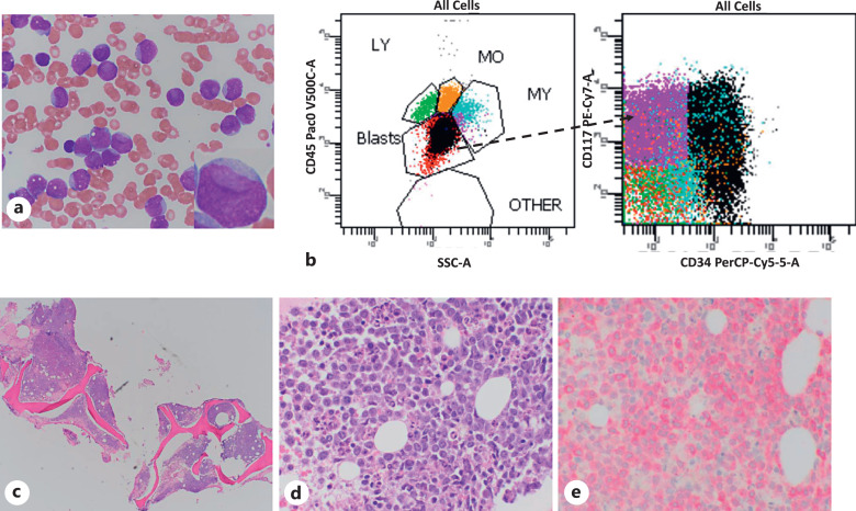NPM1-Mutated Acute Myeloid Leukemia: Recent Developments and Open Questions.
