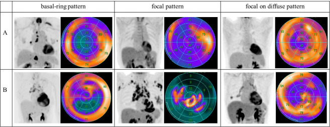 Physiological myocardial <sup>18</sup>F-FDG uptake pattern in oncologic PET/CT: comparison with findings in cardiac sarcoidosis.