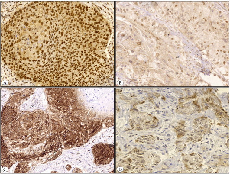Immunohistochemical Expression of Vitamin D Receptor (VDR) in Urinary Bladder Squamous Cell Carcinoma.