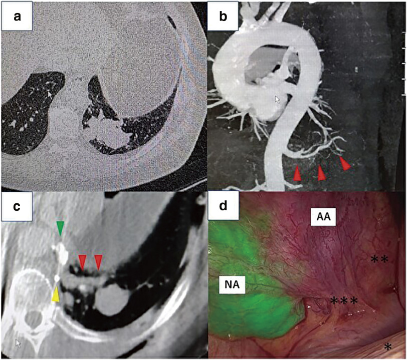 Arterial Embolization and Cone-Beam Computed Tomography-Guided Lung Resection for Anomalous Systemic Arterial Blood Supply to Normal Lung: Two Case Reports.