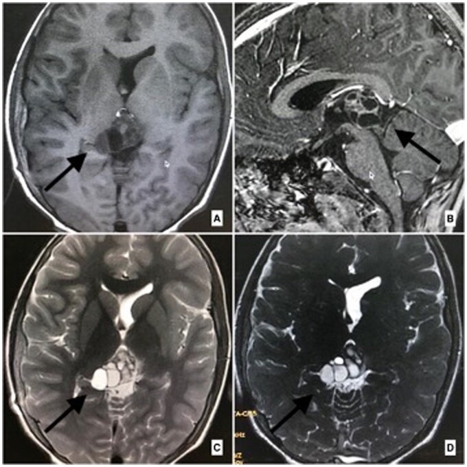 Racemose neurocysticercosis: a case series.